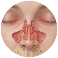 Allergies & Post-Nasal Drip