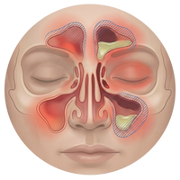Nasal Congestion
